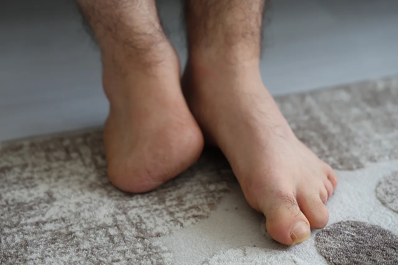 Elazığlı Ahmet Emre'nin 'biyonik' hayali: Uzuvlarını kaybetti ama azmini asla!