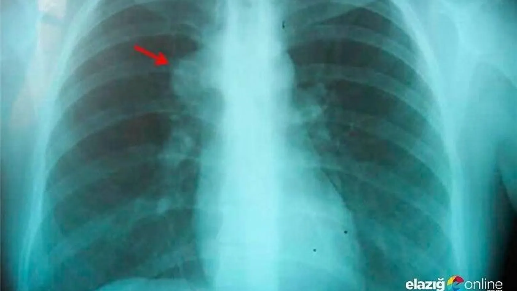 Akciğer sönmesi ne demek? Akciğer sönmesi nasıl bir hastalık belirtileri neler?