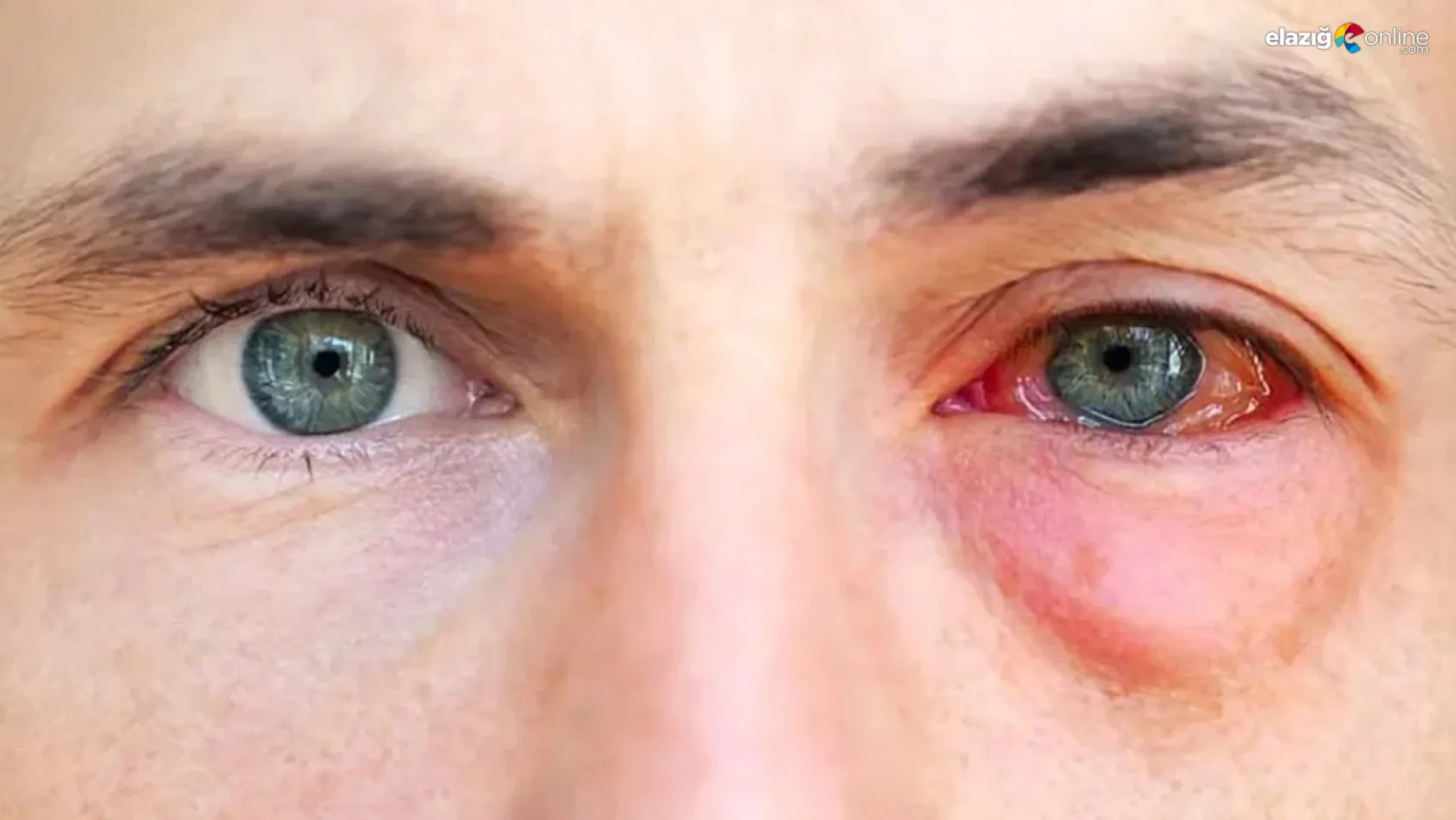 Göz alerjisi nedir ve nasıl anlaşılır? Tedavi yöntemleri nelerdir?