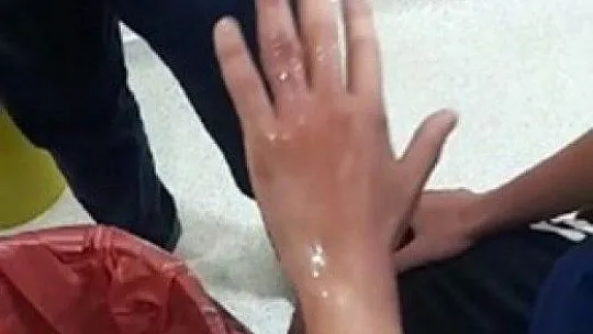 Elazığ itfaiyesinden yüzük çıkarma operasyonu