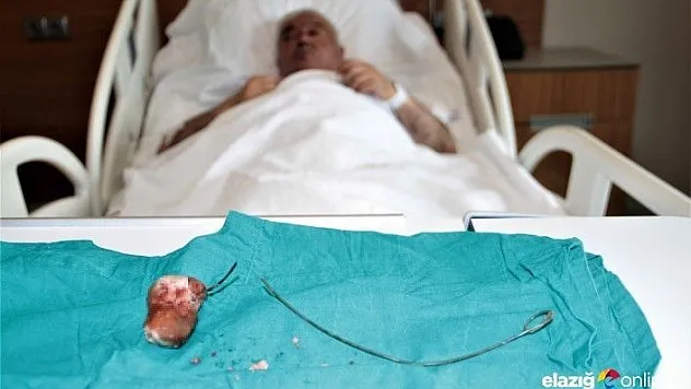 Unutulan 28 santimlik 'stent' 7 yıl sonra fark edildi