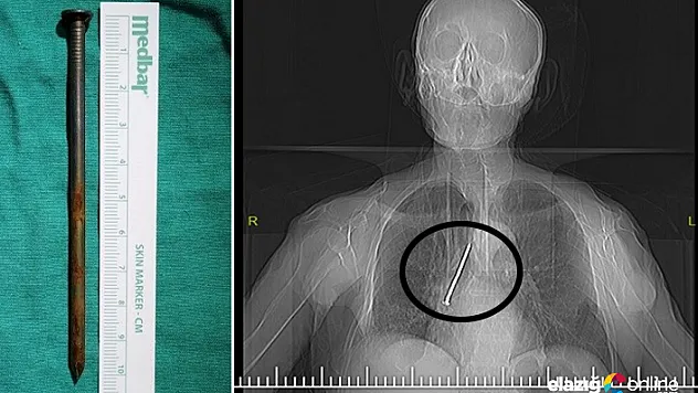 Yaşı adamın soluk borusuna kaçan çivi çıkarıldı