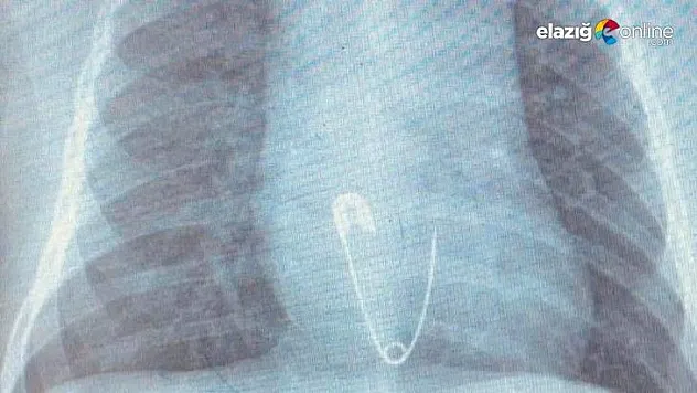 5 aylık bebeğin yuttuğu çengelli iğne operasyonla çıkarıldı