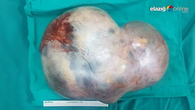 Diyarbakır'da 17 yaşındaki kızın karnından 5 kiloluk tümör çıktı, doktor gözlerine inanamadı