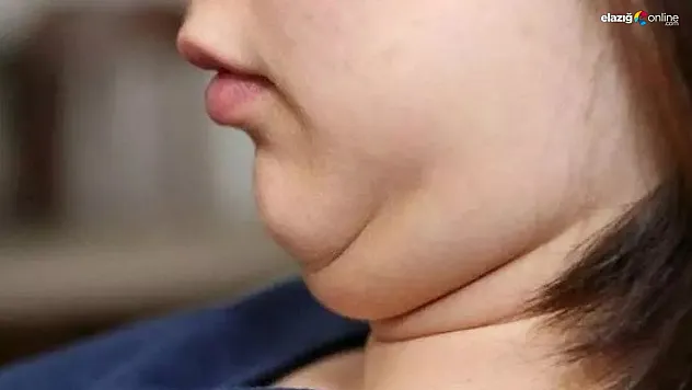 Gıdı sarkmasıyla mücadelede uzman tavsiyeleri! Kolay yollarla sıkı bir görünümün ipuçları