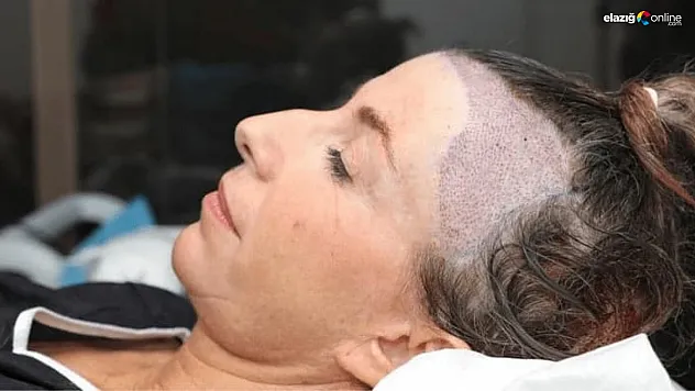 Kadınlarda saç ekimi yapılır mı? Kadınlarda saç ekimi nasıl yapılır ve ne kadar etkilidir? İşte süreç ve uzman görüşleri