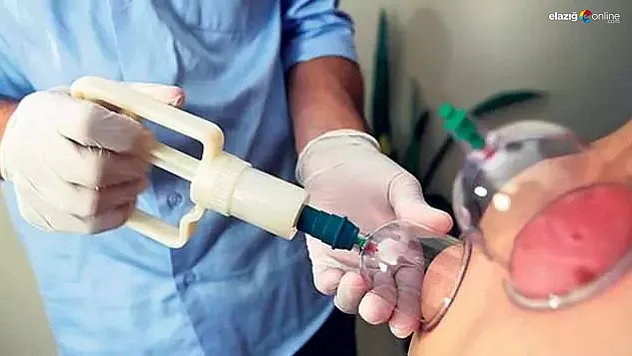 Sağlık için hacamat! Nisan ayında en etkili hacamat günleri 2024