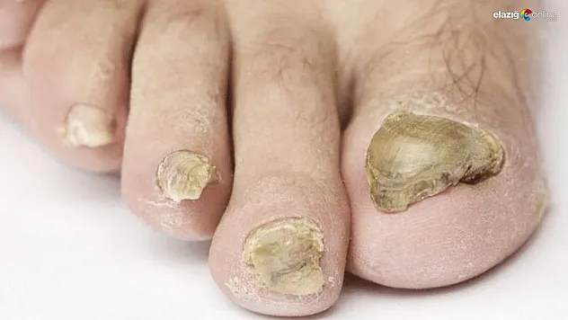 Tırnak mantarı nedir? Nasıl önlenir? İşte uzman görüşleri ve koruyucu tedbirler