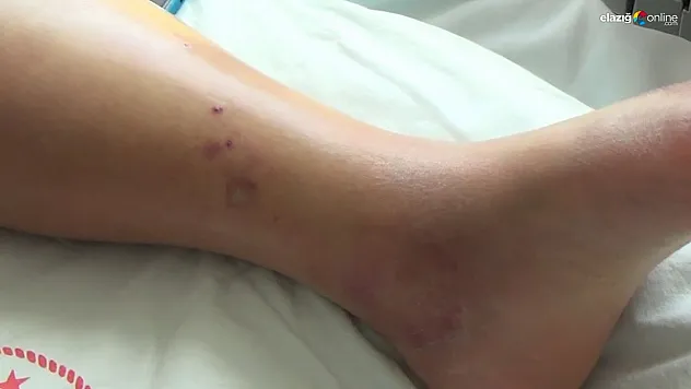 Tunceli'de koca engerek yılanının ısırdığı kadın, tedavi altına alındı