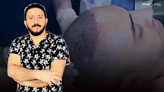 Uzmanından saç ekimi sonrası saç yıkama! İhtiyaçlar ve öneriler