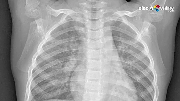 Türk mühendis, koronayı teşhis eden röntgen film sistemi geliştirdi