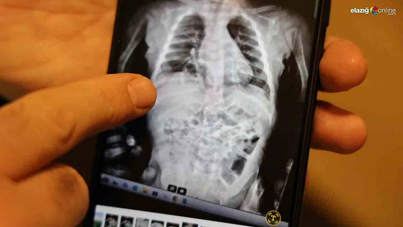 200 Binde Bir Görülen Hastalık! 2 Yaşındaki Aram Mucizeyle Hayata Tutundu