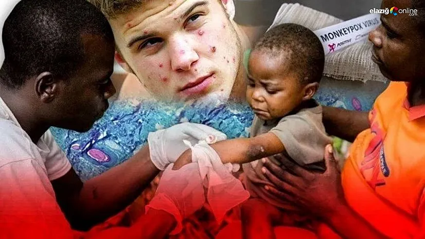 Maymun çiçeği salgınında korkulan oldu! DSÖ acil durum ilan etti