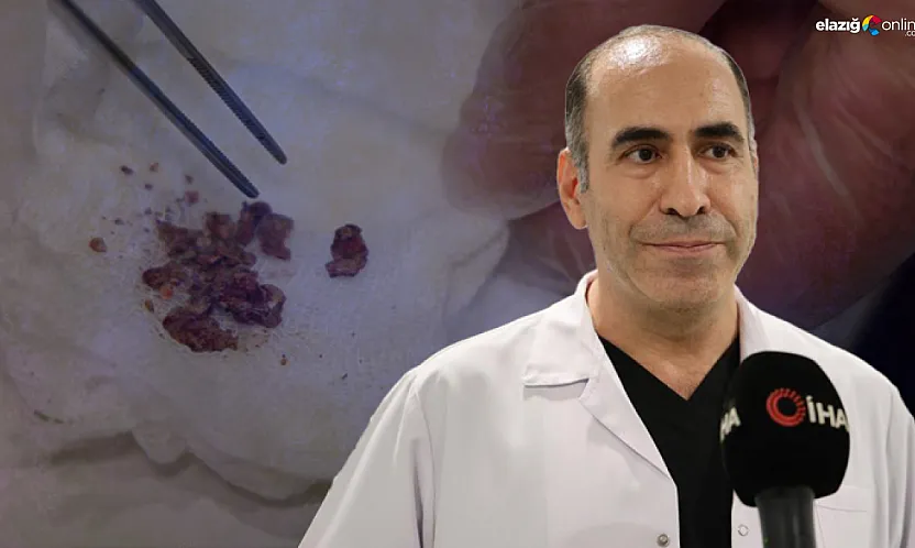 Yıllar sonra ortaya çıktı: Elazığ'da burun ameliyatında taş sürprizi